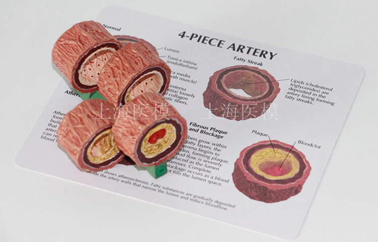 4-Stage Cross Section Human Artery Atherosclerosis Anatomical Mode Thrombotic process - Image 3