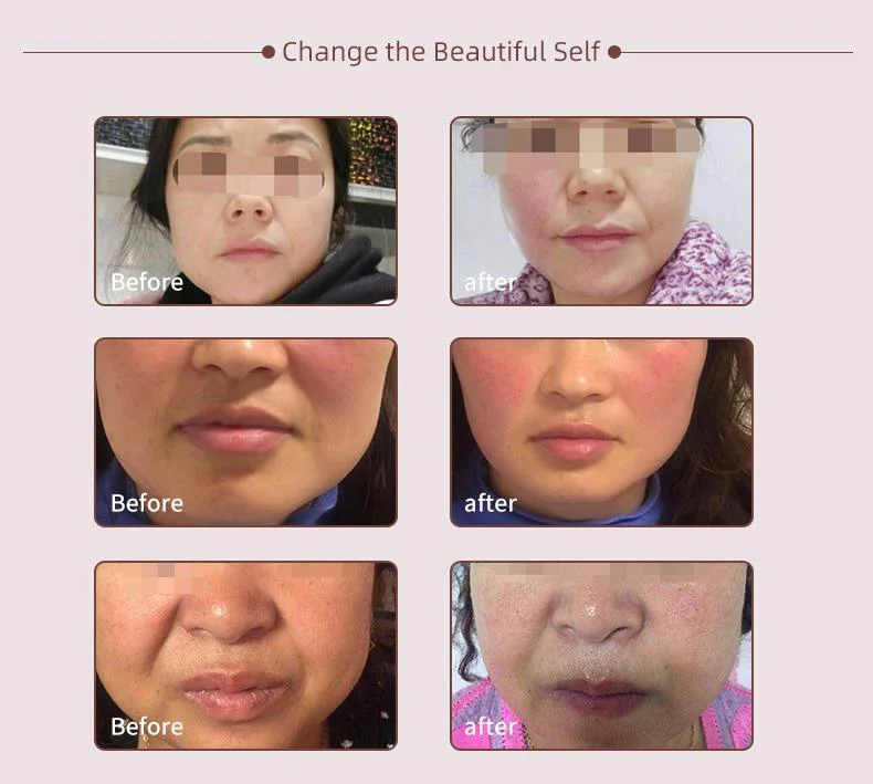 5 in 1 Quantum Hydro-Optical Facial Beauty Apparatus Skin RF Lifting EMS Mesotherapy Skin Rejuvenation Vacuum Hydration - Image 9