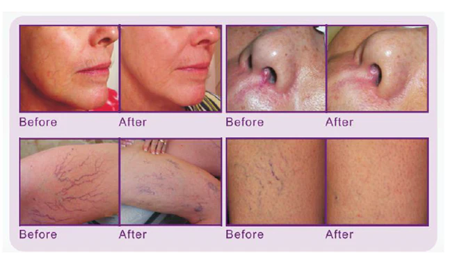 Facial Veins Remove Machine For Facial Thread Veins Red Blood Vessels Removal - Image 4