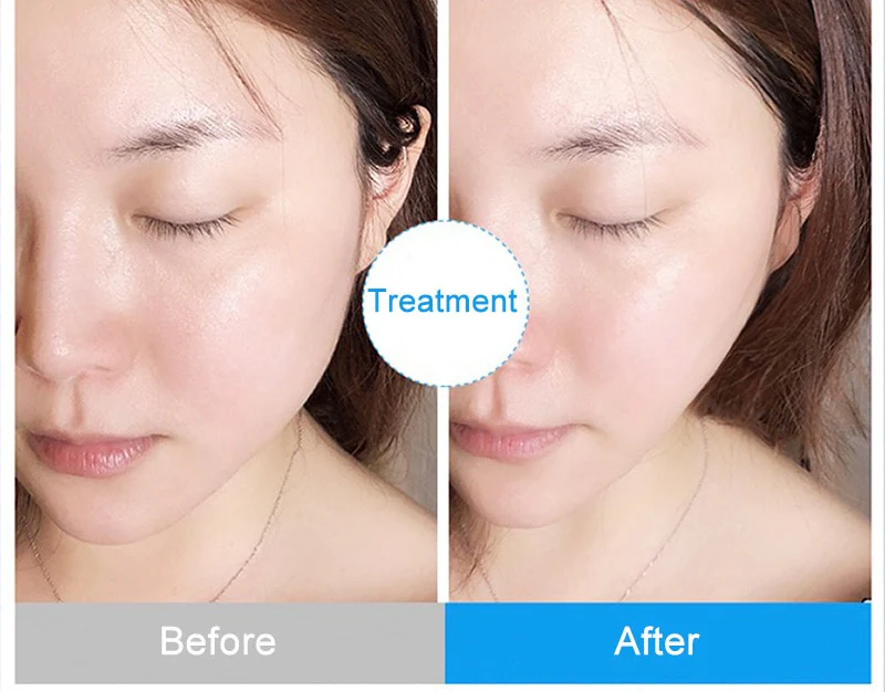 6 in 1 Hydro Dermabrasion Machine Mesotherapy Oxygen Jet Peeling Face Cleansing Skin Care Device - Image 11