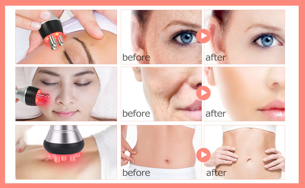 3 IN 1 RF Skin Tightening Machine Tripolar RF Radio Frequency Facial Lifting Machine Body Face Massager Wrinkle Remover Anti Aging Device - Image 7